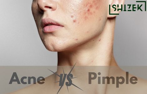 difference between acne and pimples